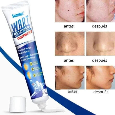 Wart Remover - Renovedor de verrugas T